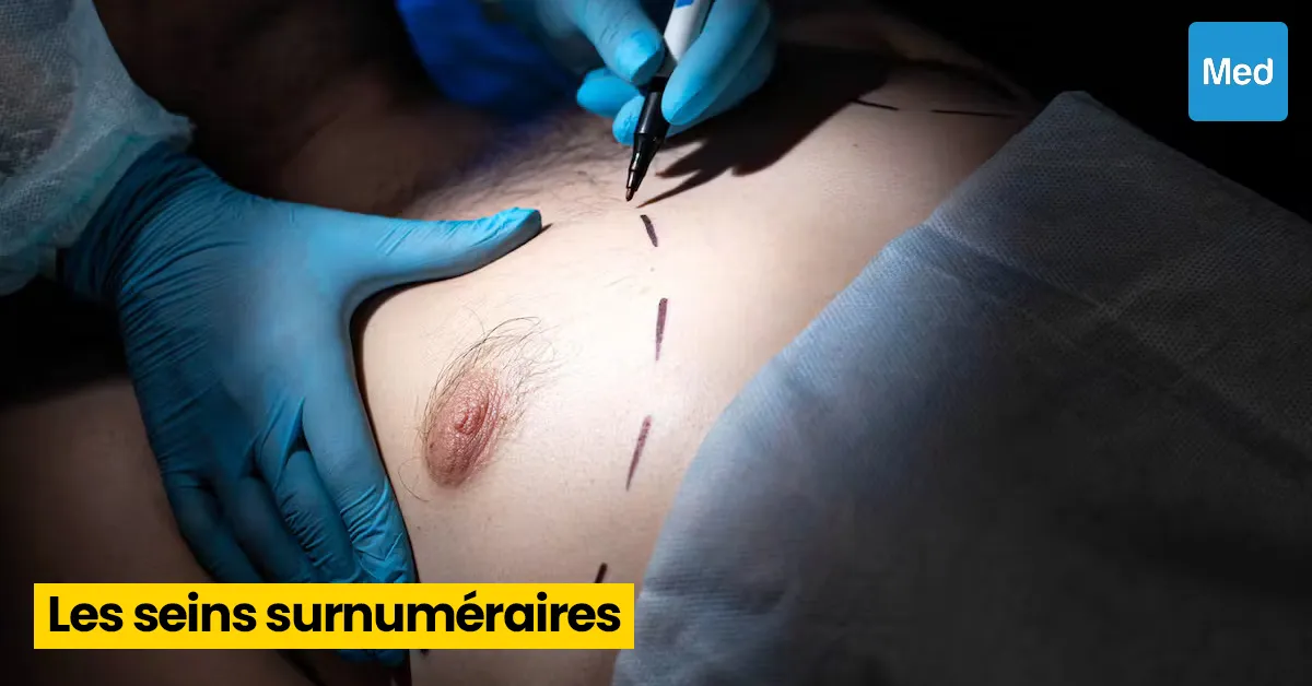 Les seins surnuméraires